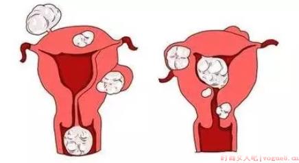 有子宫肌瘤想生娃要手术吗 有子宫肌瘤想生娃怎么手术
