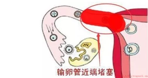 输卵管堵塞是吃药还是手术效果好 输卵管堵塞手术治疗方法