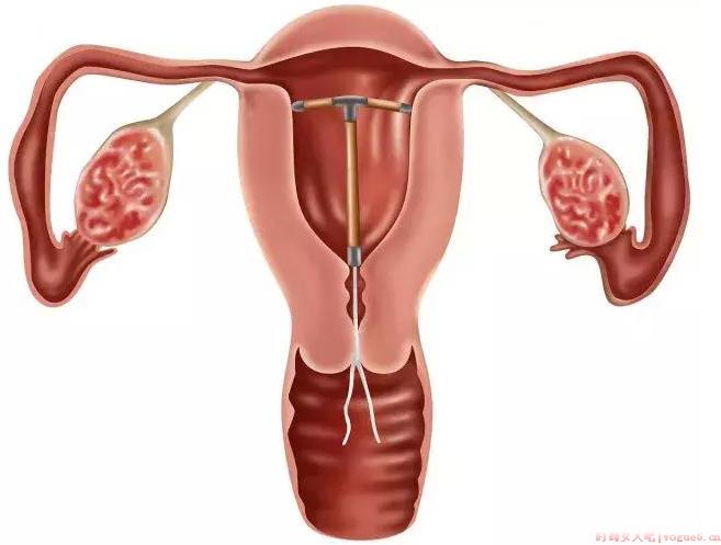 取环后迟迟不怀孕是怎么回事 取环后怎么快速怀孕