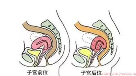 子宫后位的影响有哪些 子宫后位会导致不孕吗