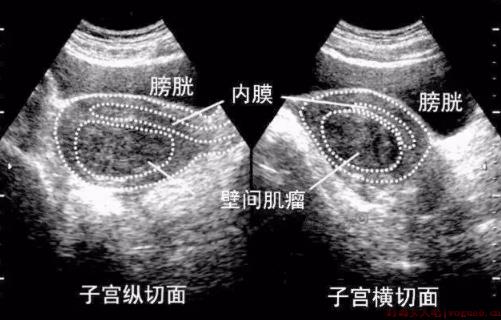 患上子宫肌瘤不想开刀能怀孕吗