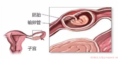 输卵管通而不畅可以喝中药吗 卵管通而不畅喝中药效果好吗