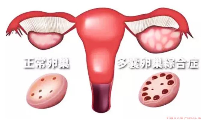 多囊患者可以自然排卵吗