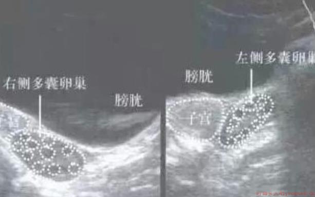 卵巢多囊样改变和多囊综合征区别 卵巢多囊样改变是什么