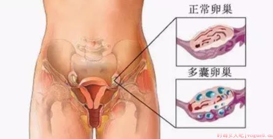 卵巢多囊样改变怎么治疗 卵巢多囊样改变会影响怀孕吗