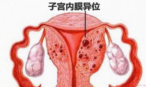 子宫内膜异位症还能怀孕吗 女性子宫内膜异位症严重吗