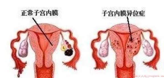 子宫内膜异位症手术后能怀孕吗