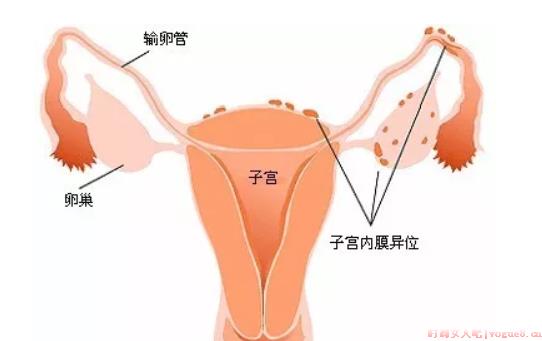 子宫内膜异位症手术后能怀孕吗 子宫内膜异位症会痛经吗