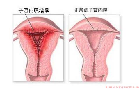 子宫内膜太薄不来月经怎么办 子宫内膜太薄和不来月经有关吗