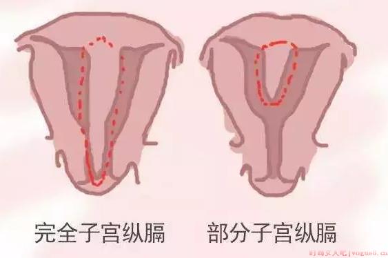 备孕检查子宫纵膈是什么 子宫纵隔为什么怀孕难