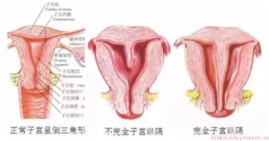 子宫纵膈影响怀孕吗 导致子宫纵膈的原因有哪些