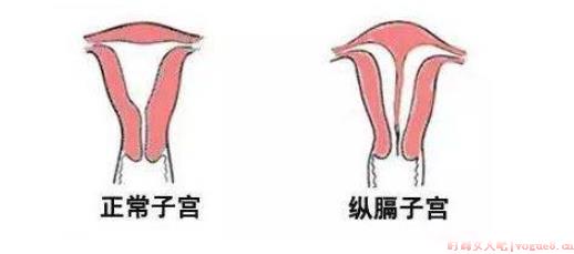 得了纵膈子宫能怀孕吗 子宫纵隔的症状有哪些