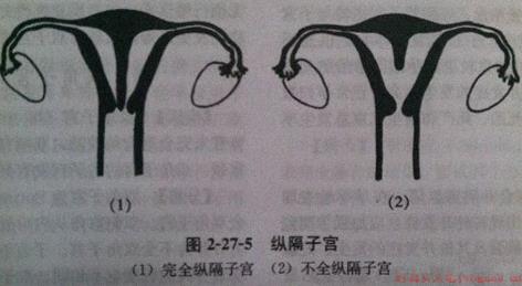 子宫纵隔一定要做手术吗