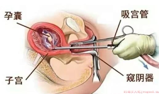 宫腔粘连是怎么回事 宫腔粘连要做什么检查判断