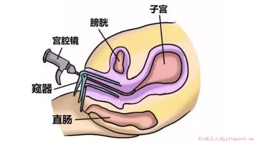 宫腔异常出血是怎么回事 宫腔异常出血怎么检查治疗