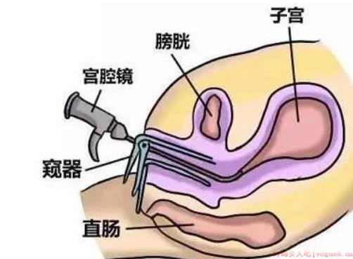 宫腔镜检查后多久可以有性生活