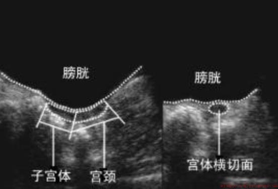 幼稚子宫可以生育吗 幼稚子宫怎么成功备孕