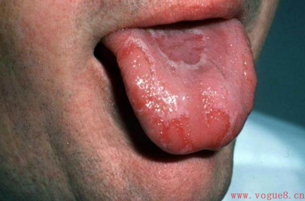 舌苔脱落是什么原因