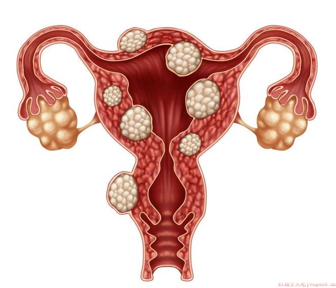 子宫肌瘤怀孕了对胎儿有没有影响 子宫肌瘤是怎么形成的