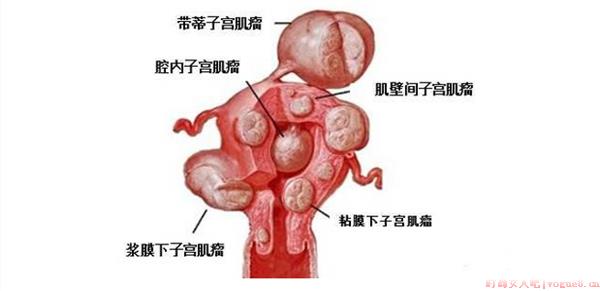 怀孕得了子宫肌瘤会影响胎宝宝吗 子宫肌瘤怀孕了有必要保胎吗