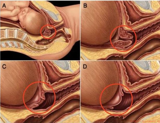 宫颈管消失是什么意思 宫颈管消失后多久分娩