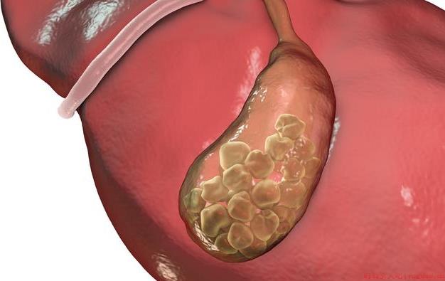 孕妇容易得胆结石吗 怀孕得了胆结石会有些哪些危害