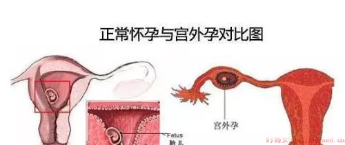 孕早期如何预防宫外孕 外孕都有哪些症状表现