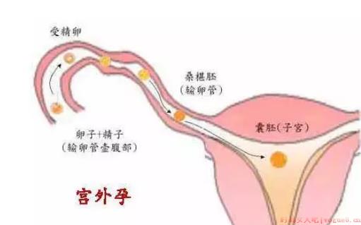 孕早期如何预防宫外孕 外孕都有哪些症状表现