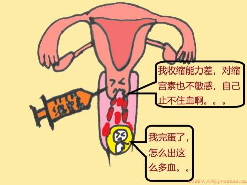 宫颈妊娠要做清宫手术吗