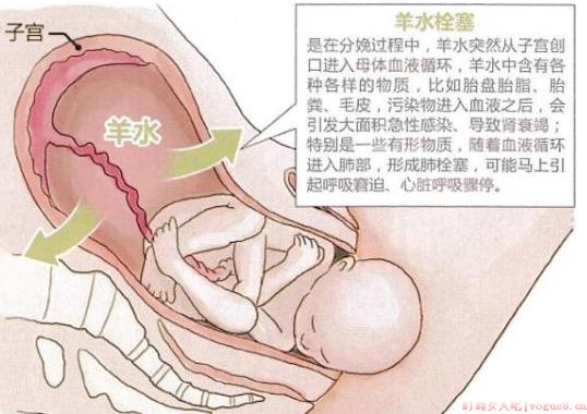 羊水栓塞可以完全预防吗 羊水栓塞能提前检查出来吗