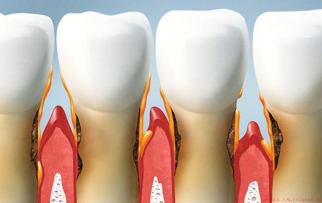 妊娠期牙龈炎的症状表现有哪些 怀孕牙龈炎的危害