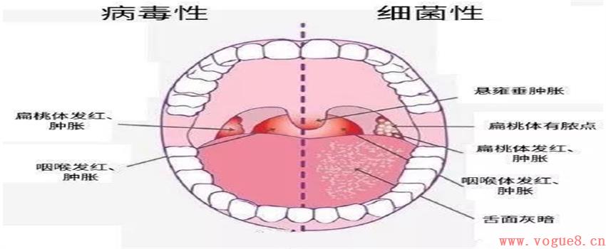 幼儿扁挑体化脓要怎么办